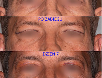 blefaroplastyka