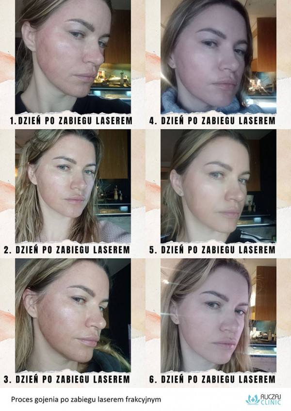 Ablacyjny Laser Frakcyjny CO2 Medycyna Estetyczna Kosmetologia ablacyjny-laser-frakcyjny-co2-medycyna-estetyczna-kosmetologia