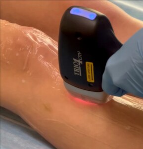 Depilacja laserowa Kraków — zabieg laserem Soprano Ice Titanium w Ruczaj Clinic